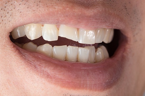 Closeup of smile with chipped tooth